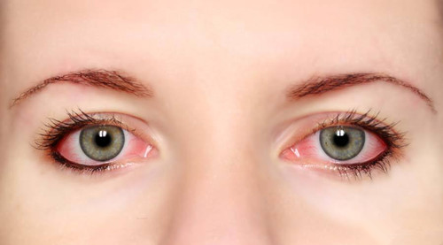 红眼病冬季多发少开空调 眼睛红不一定是红眼病