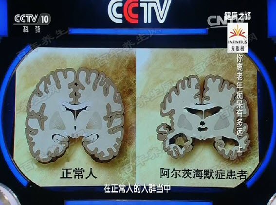 阿尔兹海默症患者的脑部沟回和正常人的脑部沟回