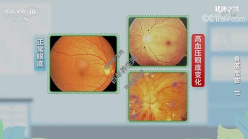 正常眼底VS高血压眼底