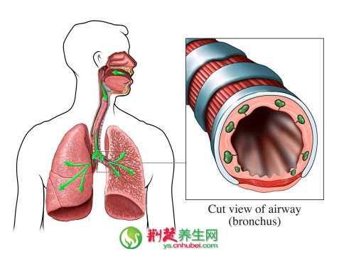 支气管炎患者要注意哪些健康常识