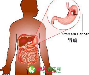 胃溃疡发生癌变有哪些症状