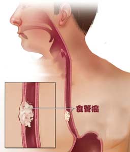 常见的诱发食道癌的病因