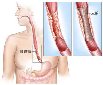 生活中食道癌形成的原因有哪些