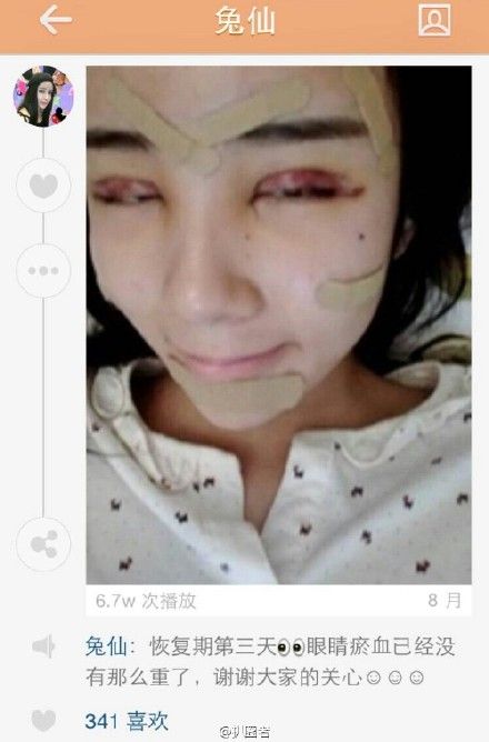 15岁少女为情整容 洪尧＂小三＂李蒽熙遭扒皮