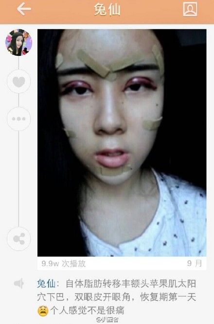 15岁少女为情整容 洪尧＂小三＂李蒽熙遭扒皮