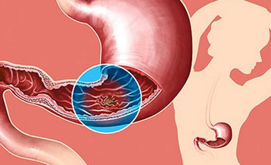 胃癌的的早期症状 急剧消瘦及严重贫血
