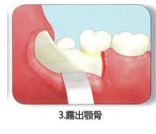 智齿一定要拔吗 了解牙医是怎么拔智齿的