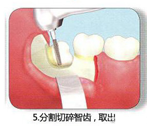 智齿一定要拔吗 了解牙医是怎么拔智齿的