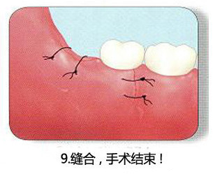 智齿一定要拔吗 了解牙医是怎么拔智齿的