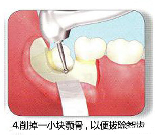 智齿一定要拔吗 了解牙医是怎么拔智齿的