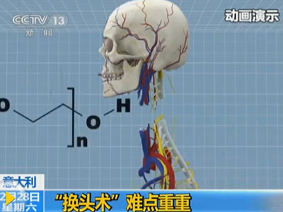 首例换头手术将在中国进行 换头术风险大吗