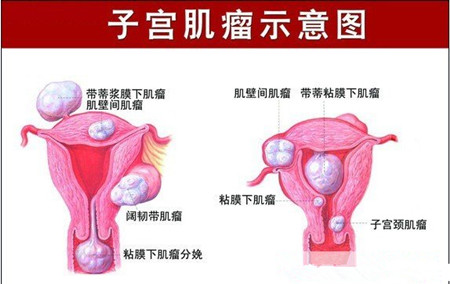 子宫肌瘤的症状 子宫肌瘤不能吃什么