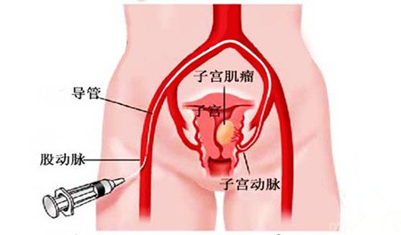 子宫肌瘤的症状 子宫肌瘤不能吃什么(2)