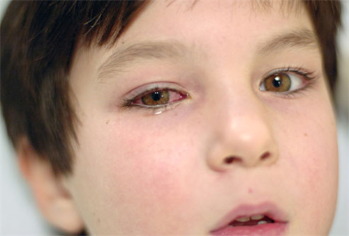红眼病的保健方法 预防红眼避开这2个误区