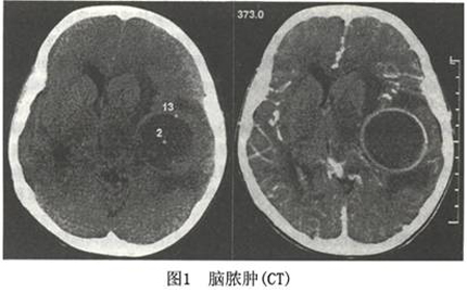 小伙纹身致血液感染 脑内长7个“脓包”