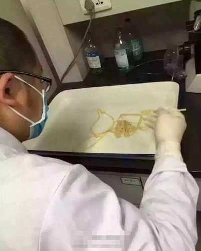 男子常吃生鱼片生牛肉 体内取出5米长牛带绦虫(2)