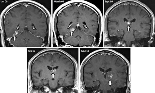 19岁小伙大脑里游着一条寄生虫 医生：喝凉水易感染