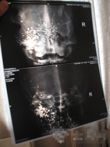 熊孩子玩射钉枪击中堂姐 女孩脸上取出34颗铁珠