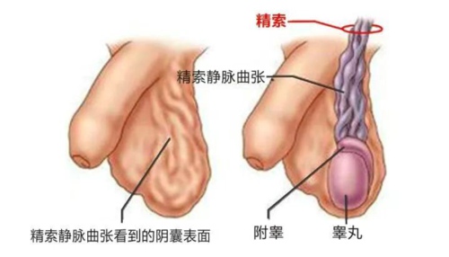 精索静脉曲张