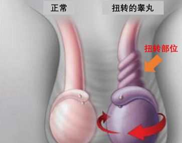 睾丸扭转能自己恢复吗